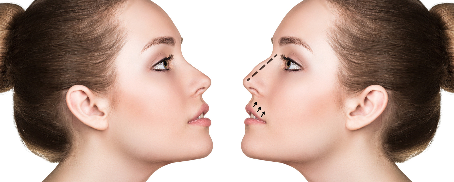 Geplante Veränderung bei einer Nasen OP einer Patentin